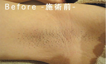 Before-施術前-
