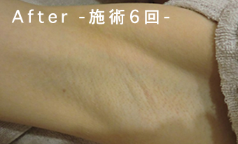 Before-施術6回-