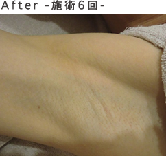 after-施術6回-