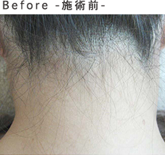 Before-施術前-