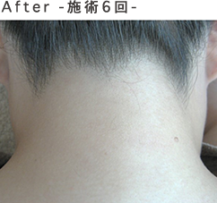 Before-施術6回-